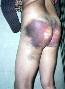 Fotografija gospođe Liu, nakon što je pretučena i silovana od strane kineske policije.
