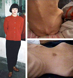 Tridesetogodišnja gđa. Wang fotografirana prije početka progona Falun Gonga u Kini (lijevo). Nakon dvije godine mučenja (desno), zatvorska uprava ju je dovela pred smrt, tražeći od njezine obitelji da je uzme kući da ne bi umrla u zatvoru.
