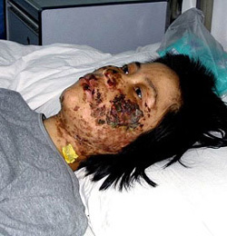 Mučenje je deformiralo lijevu stranu lica Gao Rongrong i konačno je rezultiralo njenom smrću